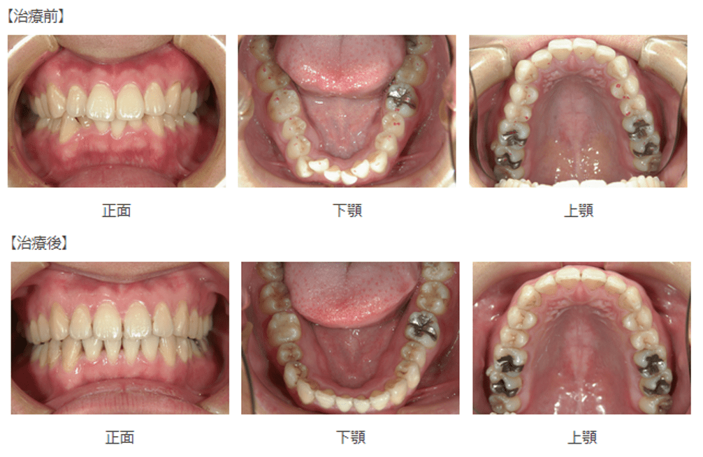 抜歯なしの症例3