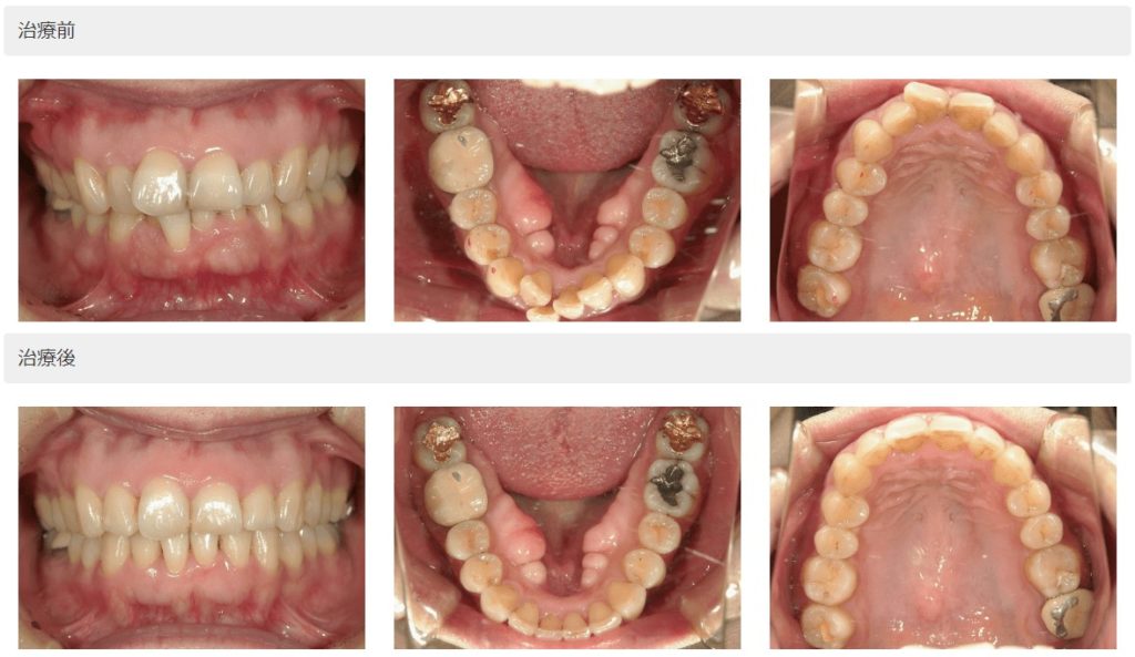 抜歯なしの症例2
