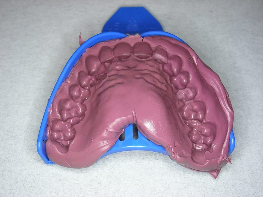 シリコンによる歯型採取画像